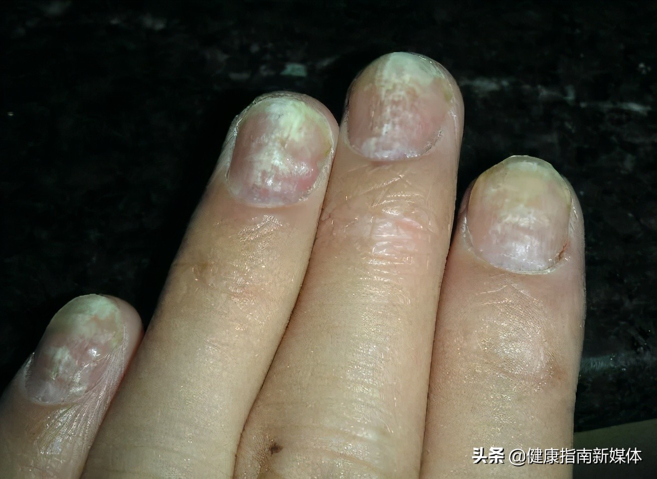 灰指甲有哪些症状呢,灰指甲有哪些危害