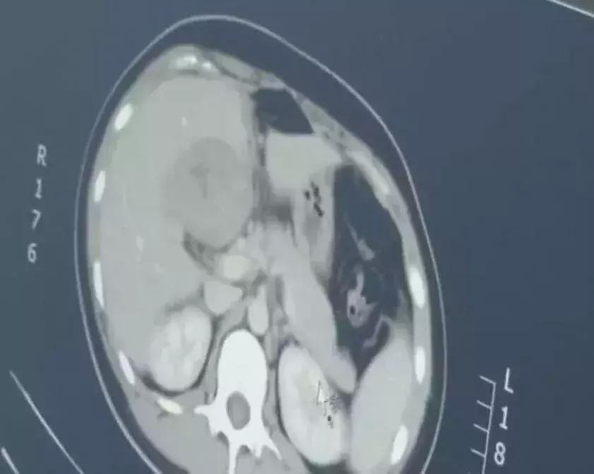 女子怀孕3个月,子宫却是空的!连见多识广的医生都吓坏了!