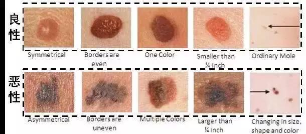 黑痣要去掉吗？专家和你聊聊关于“黑痣”的那些事儿