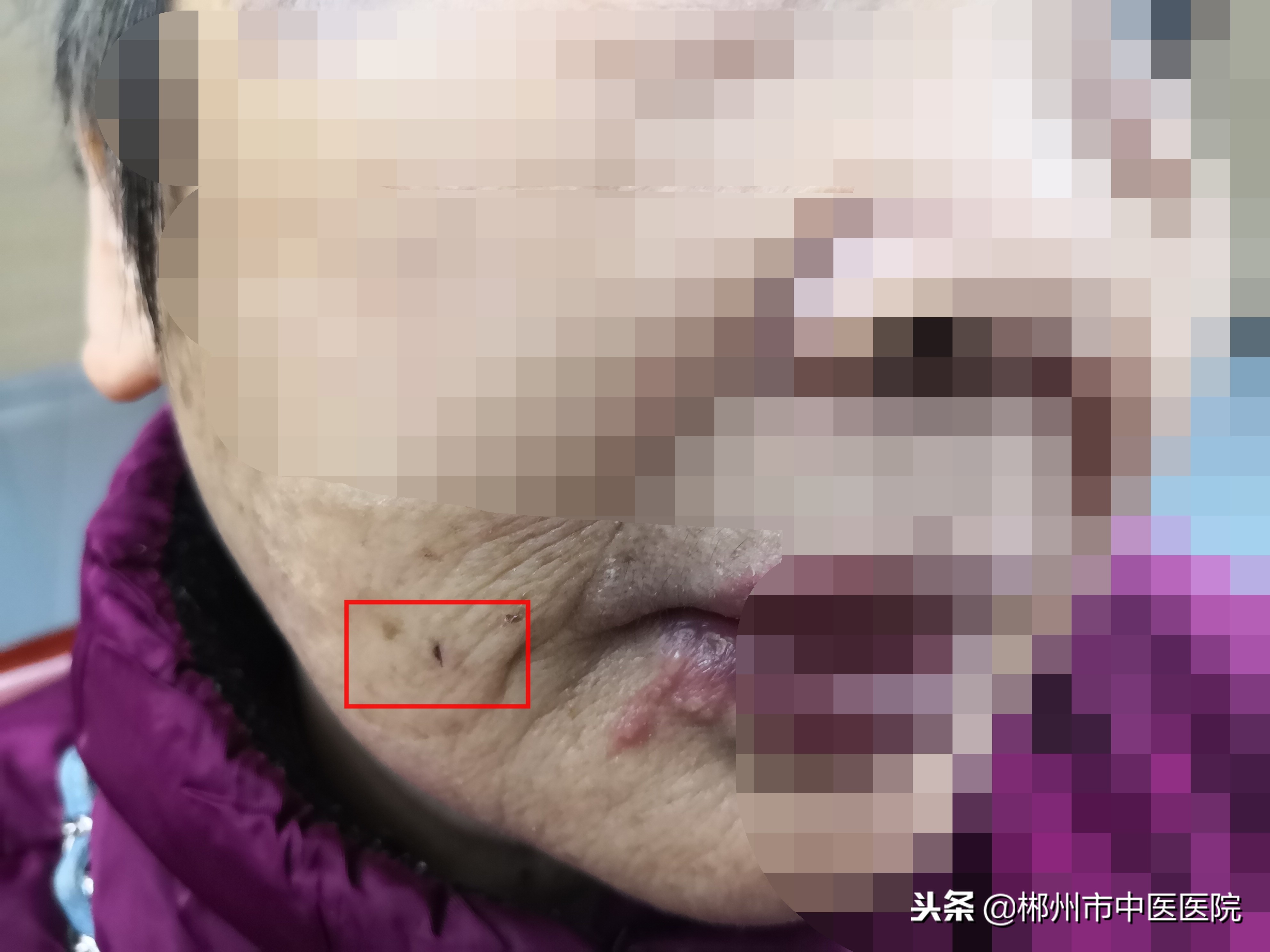 90多岁奶奶全身痛怎么治疗,七十多岁的老奶奶疼得撕心裂肺