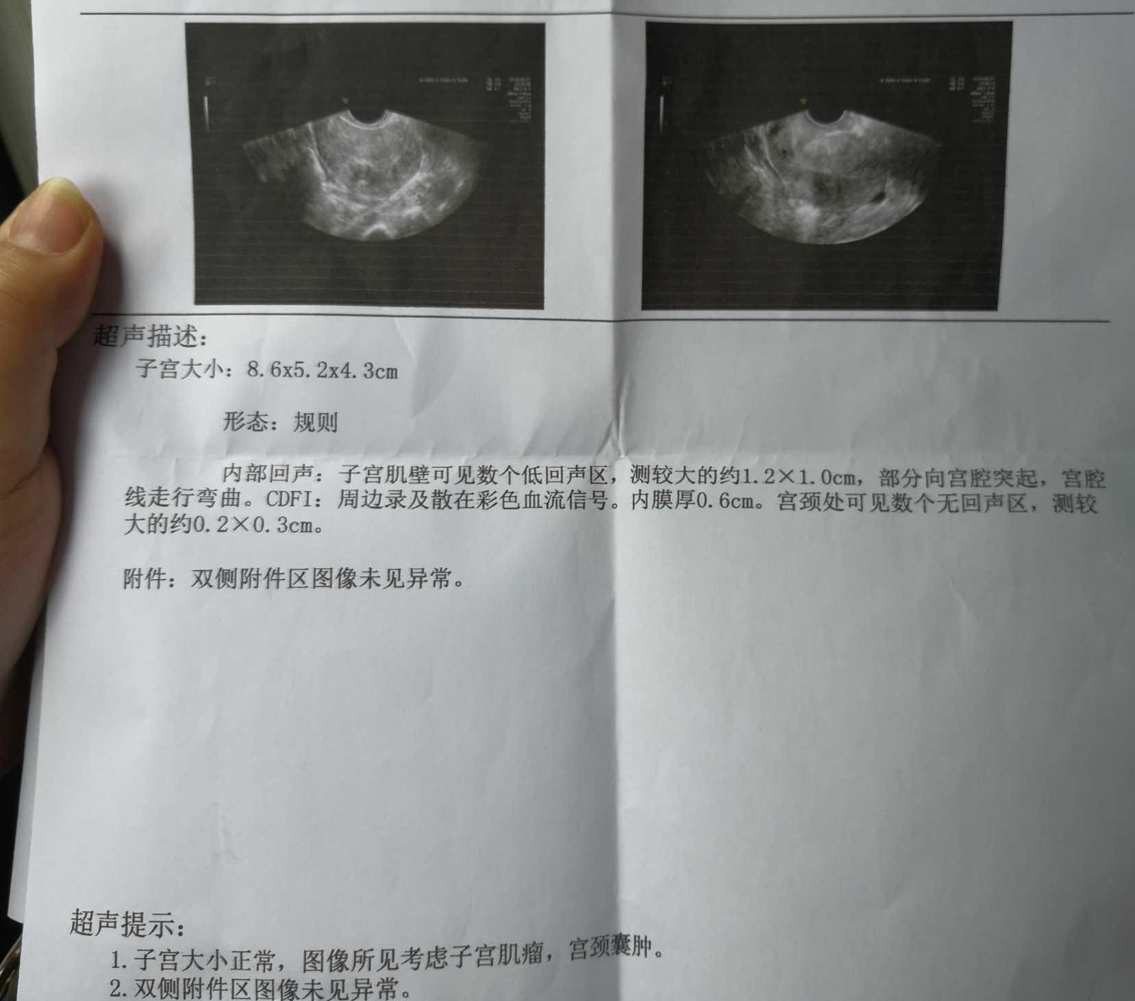 绝经期子宫肌瘤5.6厘米需要手术吗,我43岁有子宫肌瘤