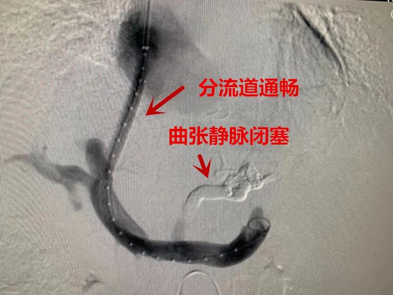 肝硬化门脉高压物理治疗方法,肝硬化失代偿期门脉高压