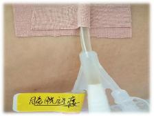 膀胱造瘘管居家护理的ppt,膀胱造瘘后在家如何护理