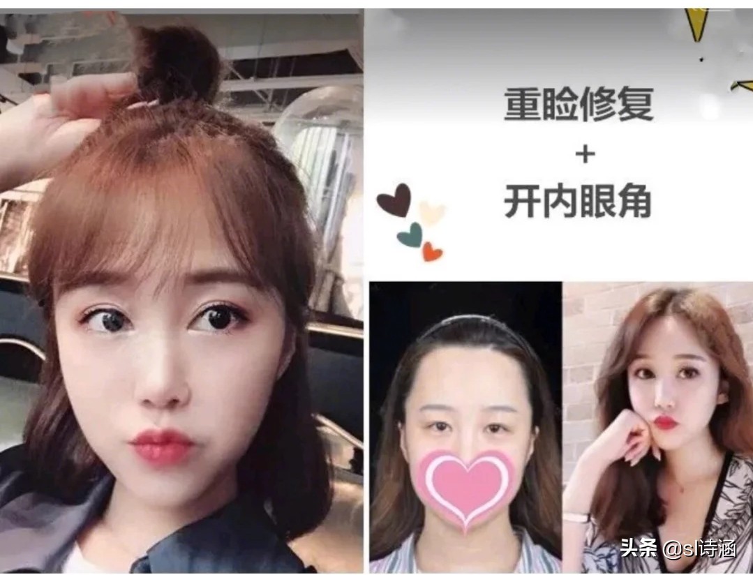 做完双眼皮后的注意事项,做完双眼皮过后应该注意些什么