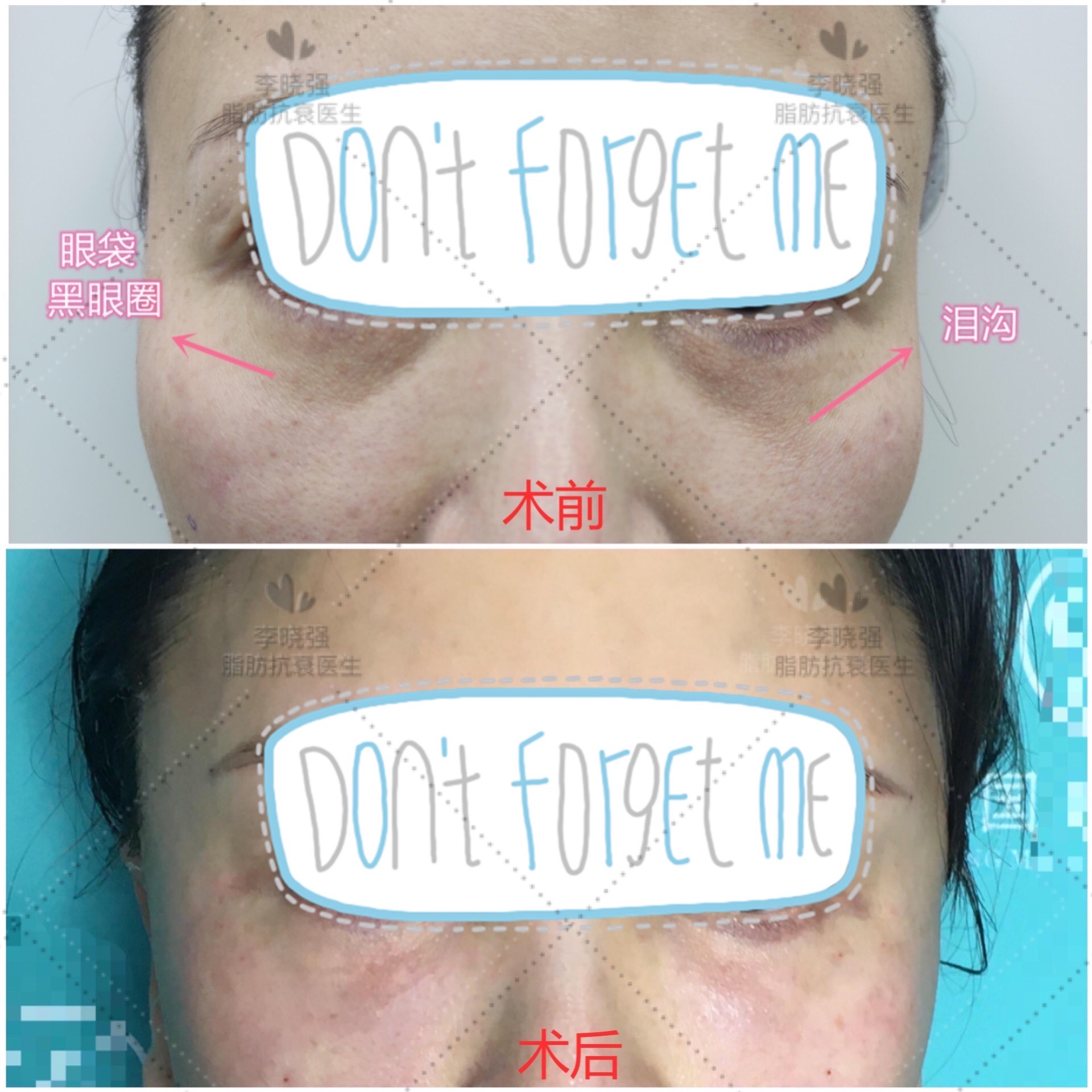 注射玻尿酸和肉毒素除皱皮肤紫红,肉毒素除皱后可以做玻尿酸填充吗