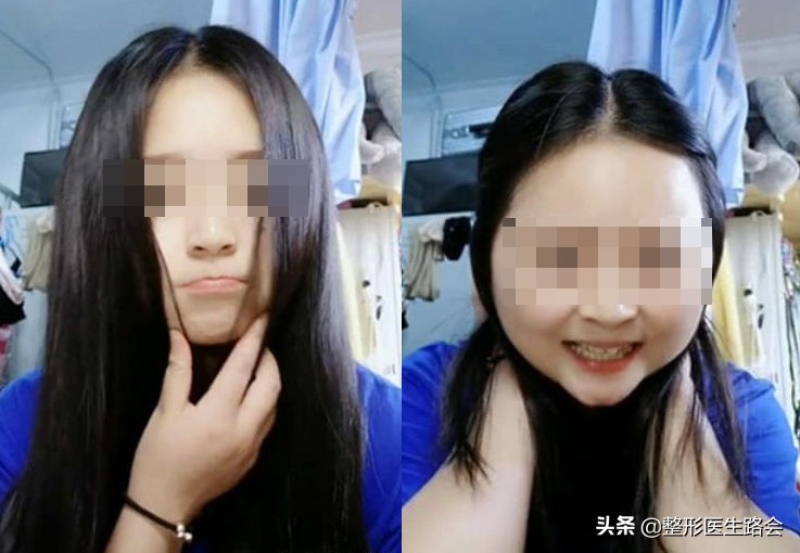 下颌角整形│对不起，你的脸让我的心好“方”