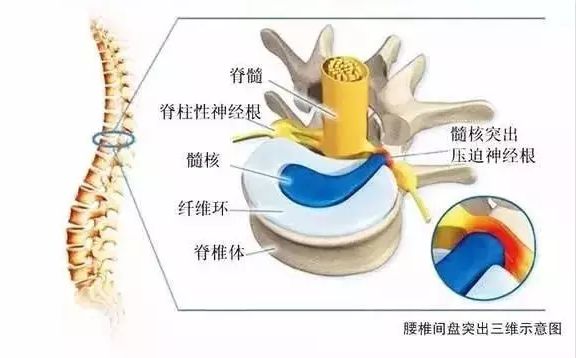 腰间盘突出、骨质增生有什么好的预防方法？