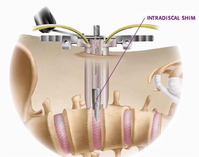 腰椎管狭窄有滑脱能做微创吗,腰椎滑脱椎管狭窄可做微创吗