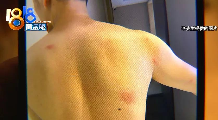 半夜客房里“赶”蟑螂,细看一身“疙瘩”