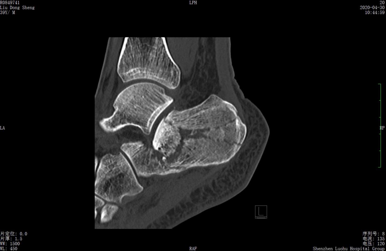 左股骨粗隆间粉碎性骨折微创手术,跟骨粉碎性骨折微创手术最快多久