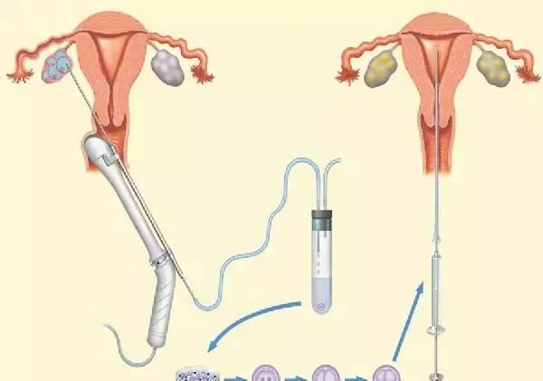 女星纷纷冻卵，这真是女星为了事业放弃孩子的最后一颗后悔药吗？