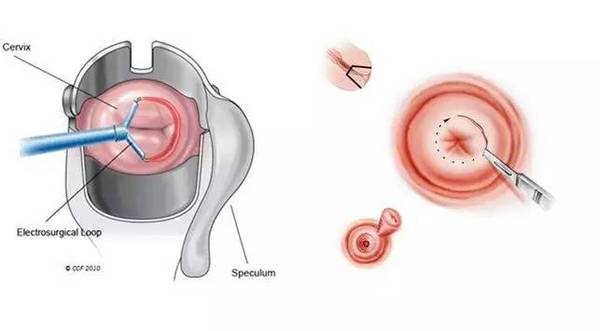 你们医生讲话这么复杂，宫颈癌筛查CIN1级到底要不要治？