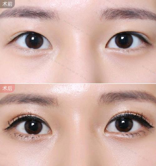 现在做双眼皮用什么方法效果最好,双眼皮有哪几种做法