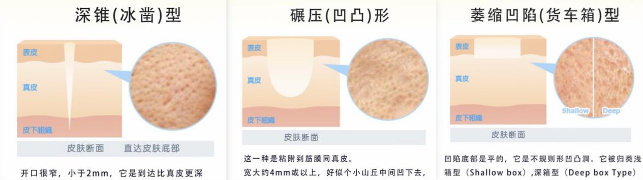 修复痘坑最有效的产品排行榜,男士痘坑痘印修复的最佳方法