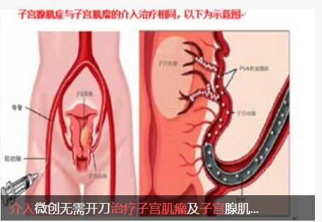 介入疗法的未来前景,介入治疗快速发展