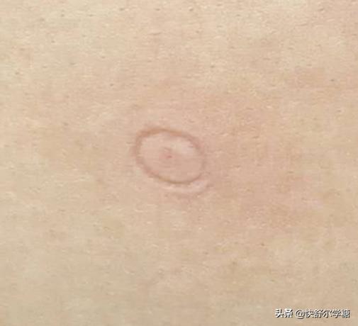 糖尿病注射胰岛素的器械在哪里买,糖尿病胰岛素无针注射器价格表