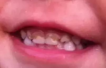 你们听说过奶瓶龋吗,如何正确防止奶瓶龋齿