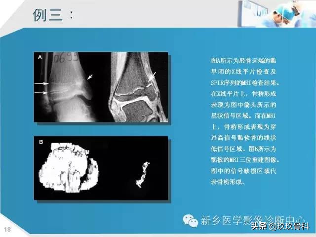 骨骺损伤x线表现,骨骺损伤磁共振表现