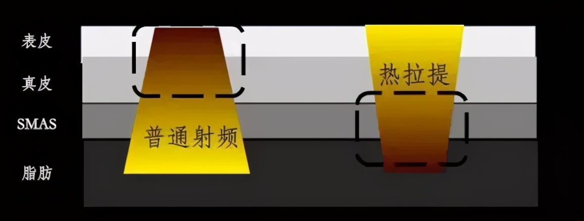 热拉提抗衰,抗衰老的杀手锏热拉提plus