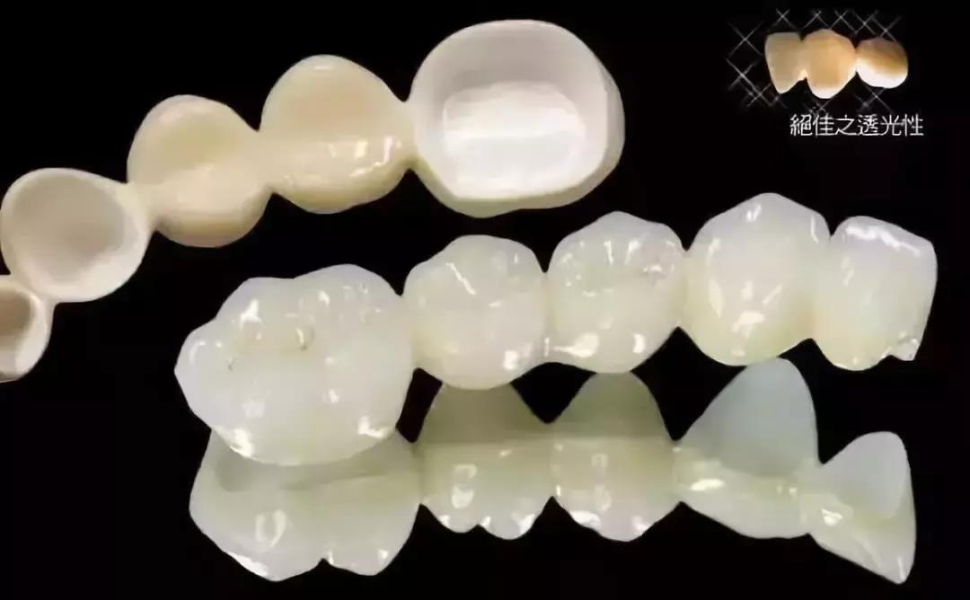 罗兰烤瓷牙,牙科最便宜的全瓷牙是什么品牌