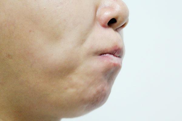 舌头吃饭咬了一口老是流血,吃饭咬舌头是什么病的前兆