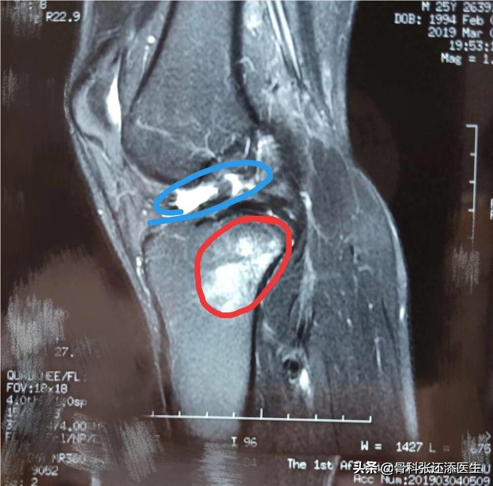 膝盖走路咯噔响还疼是什么原因,膝盖弯曲膝盖响是什么原因