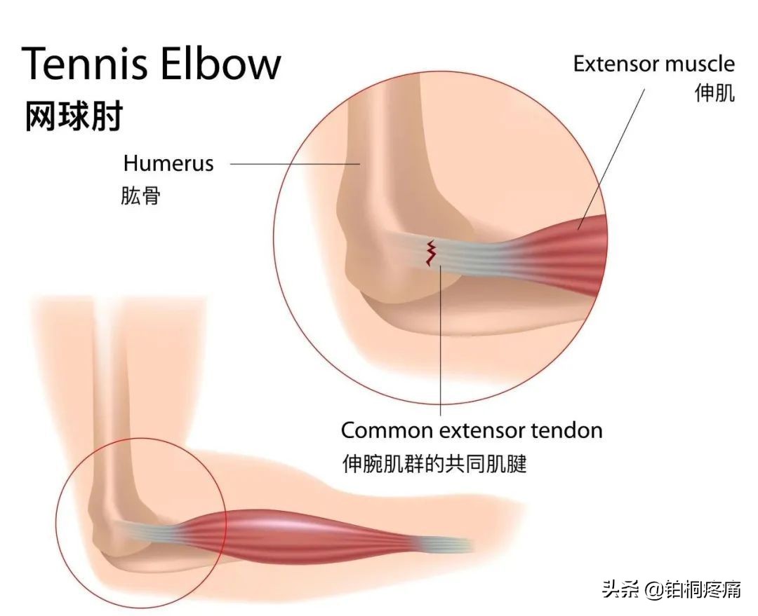 做网球肘操能治愈网球肘吗,做家务胳膊痛什么原因