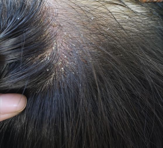 有头皮屑头痒用什么药治,头皮屑多头痒用啥洗发水