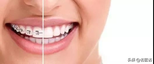 2020牙齿矫正攻略请查收,今日头条修复牙齿