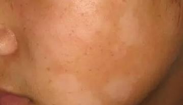 孩子脸上长白斑是怎么回事,孩子脸上长白斑用什么药膏