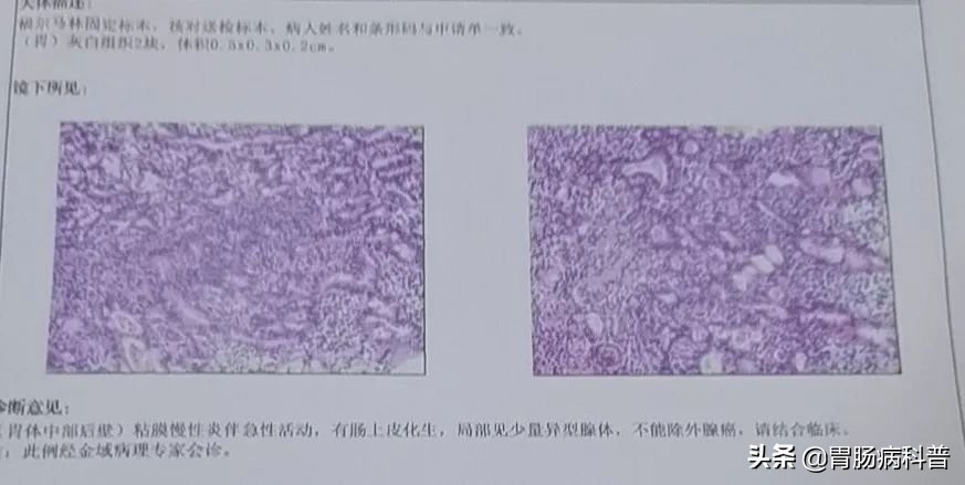 拔鱼刺胃癌早期,取一个鱼刺去了一趟医院