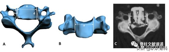 acaf手术适应脊髓型颈椎病吗,acaf术后康复方法