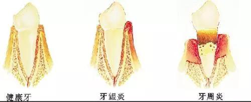 老了牙齿不好了可怎么办,人老了牙齿变稀了怎么办