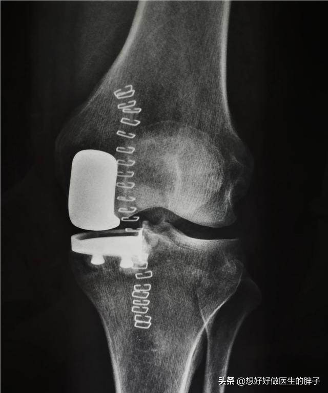 骨刺吃什么药可以抑制骨刺的生长,长骨刺独家药方喝四天就能止痛