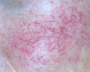 血丝脸最快的修复方法,怎样有效改善红血丝面部发红