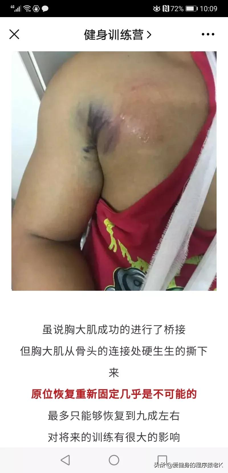 胸肌撕裂瞬间健身事故,国外著名健身大神胸肌撕裂