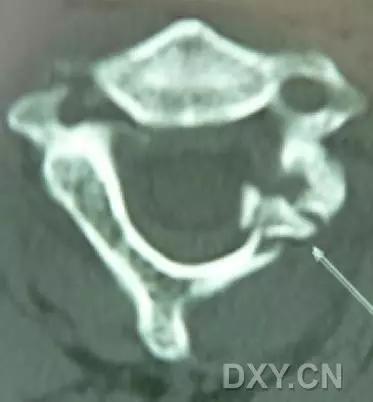 特殊骨折类型,特殊骨折体征