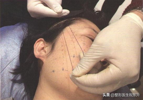 30岁做线雕提升还是筋膜悬吊,最新抗衰线雕