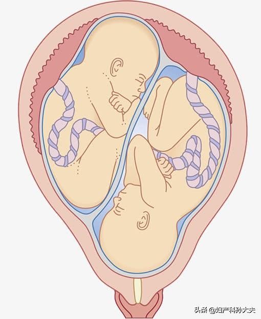 双胞胎在子宫里的发育,双胞胎怎么从子宫出来