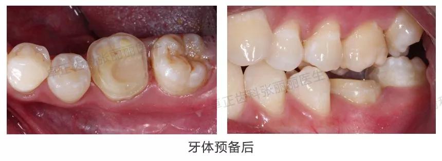 牙齿楔状缺损修复图片,牙齿楔状缺损修复大概多少钱