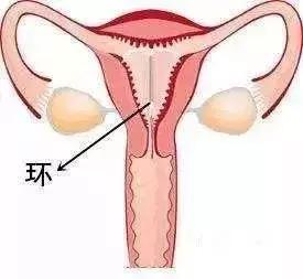 女人上环后身体会排斥，三招做好保养！你都知道？