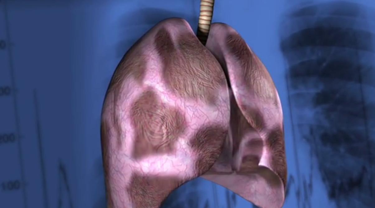 现在农村的石棉瓦有危害吗,石棉瓦盖房子有危害吗