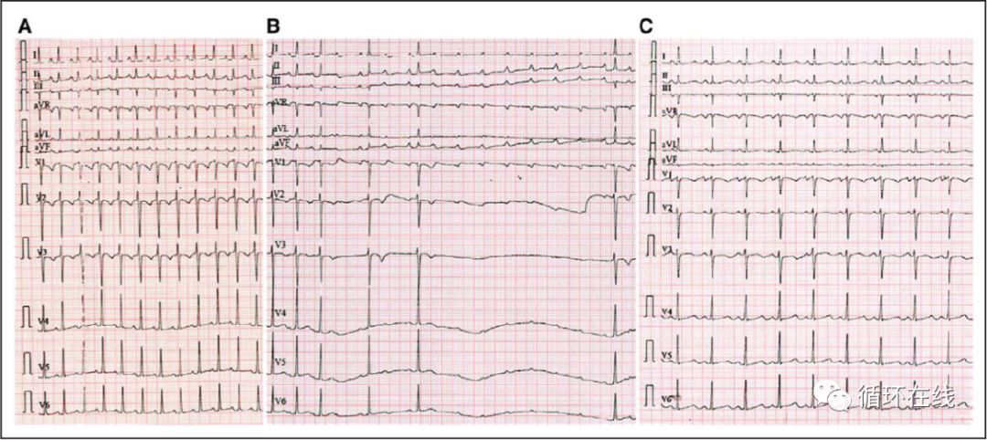 「彤心飞传」局灶房性心动过速治疗的新策略：伊伐布雷定