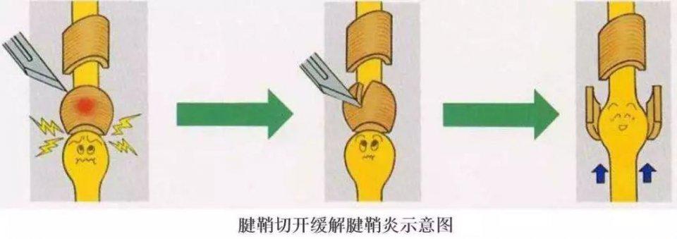 先天性拇指狭窄性腱鞘炎一定要手术吗？2岁以内可以保守治疗！