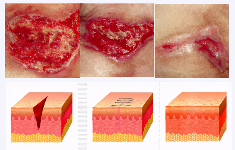 手术伤口愈合后怎么护理好得快,怎么护理伤口的视频