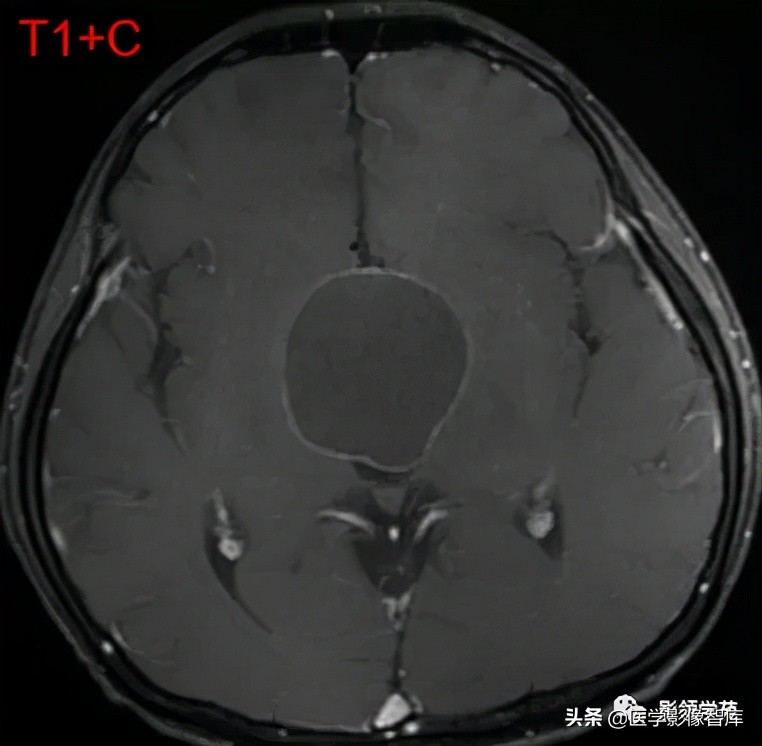 鞍区肿瘤做什么检查得出来,鞍区肿瘤的影像学鉴别