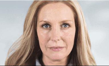 童颜针PK肉毒素