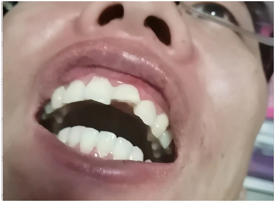 磕断了一排牙,磕断了一半门牙