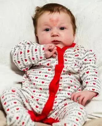 新生儿脸上身上长红斑怎么回事,身上脸上出红斑疙瘩吃什么药