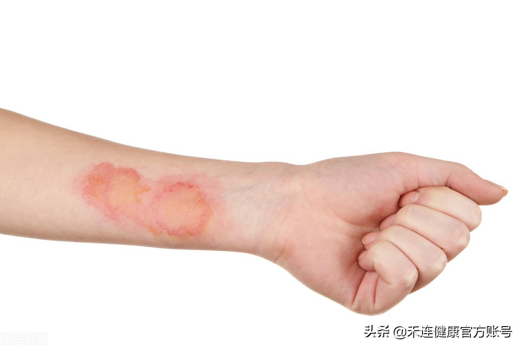 疤痕能引起癌变吗,疤痕危害大治疗要趁早